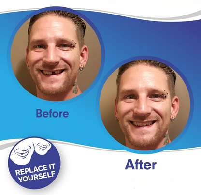 Snap-On Smile Veneers – Upper & Lower Teeth Covers for a Perfect Smile